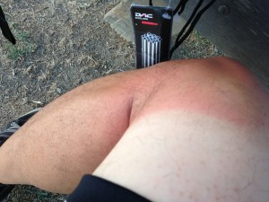 Johnny's sunburn leg